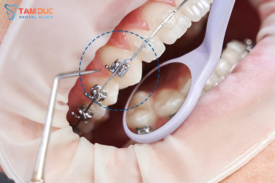 Gắn mắc cài niềng răng tại Nha khoa Tâm Đức Nghệ An – Khởi đầu hành trình nụ cười hoàn hảo