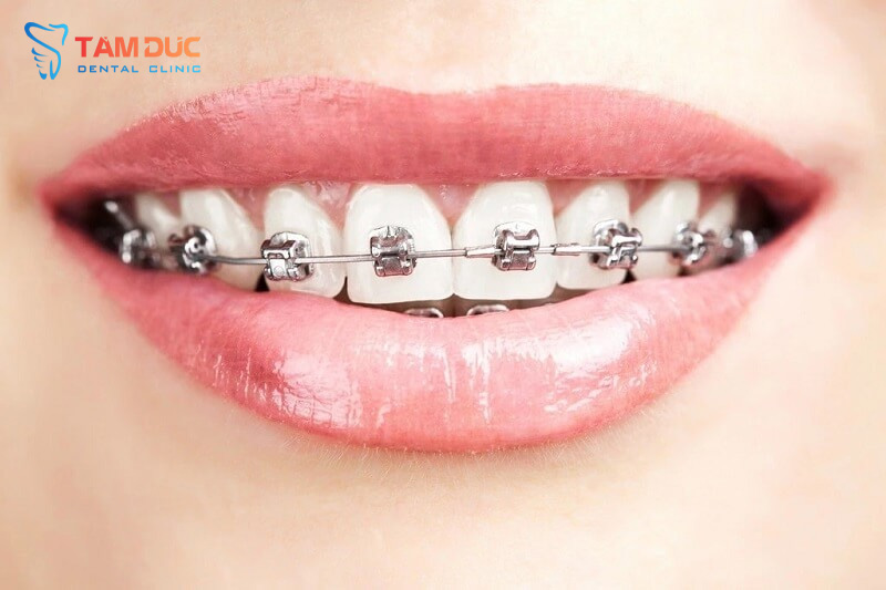 Gắn mắc cài niềng răng tại Nha khoa Tâm Đức Nghệ An