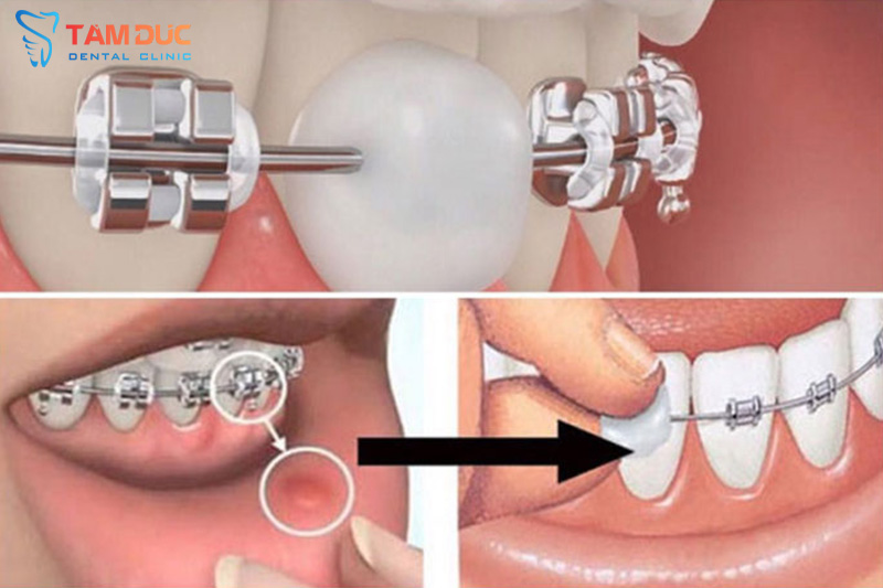 Quy trình gắn mắc cài niềng răng